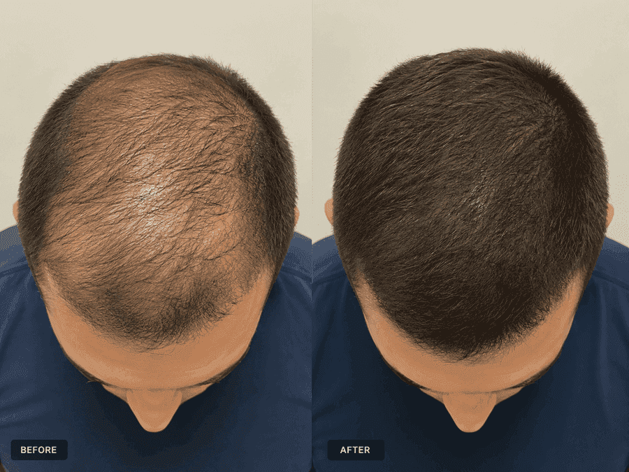 Before and after results for a male HairGain® patient showing crown regrowth